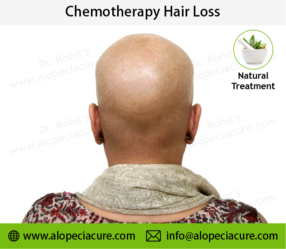 Chemotherapy Hair Loss Result 3