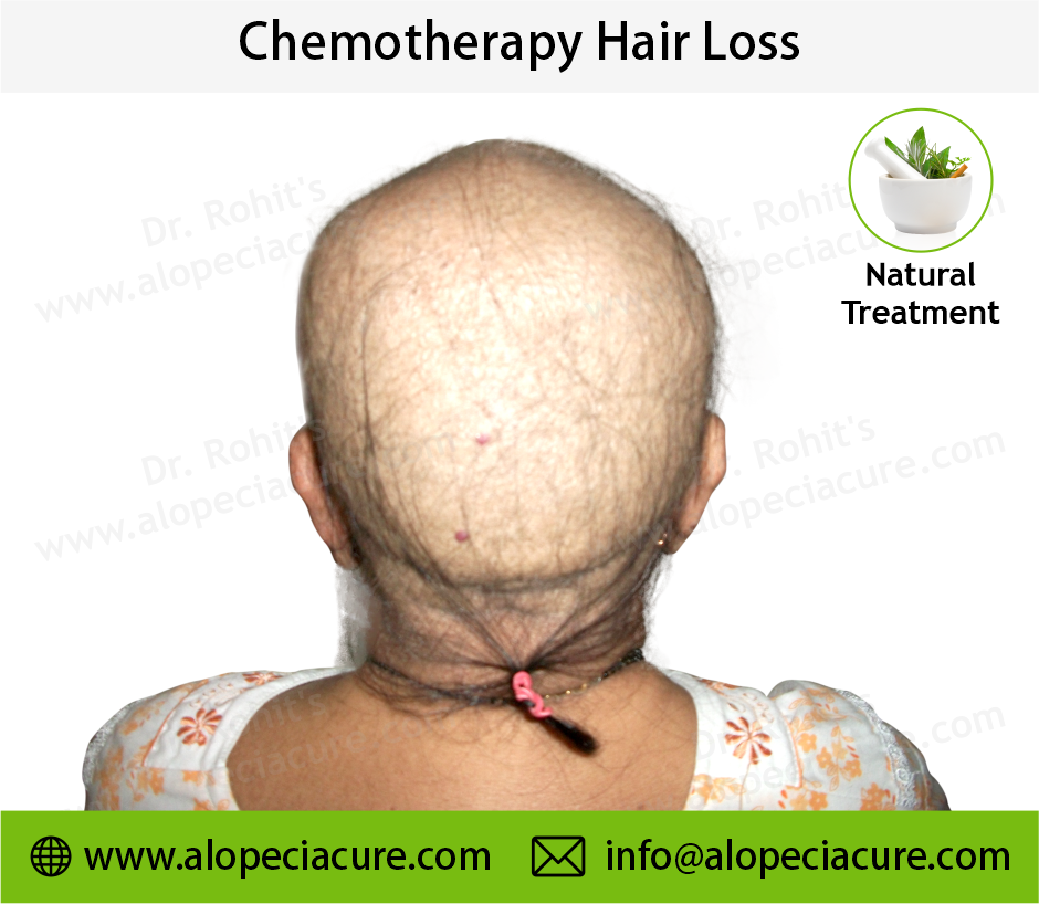 Chemotherapy Hair Loss Result 4