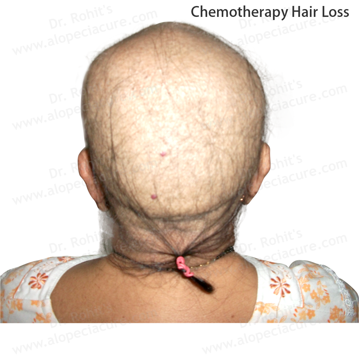Chemotherapy Hair Loss Clinical Treatment Slide 1