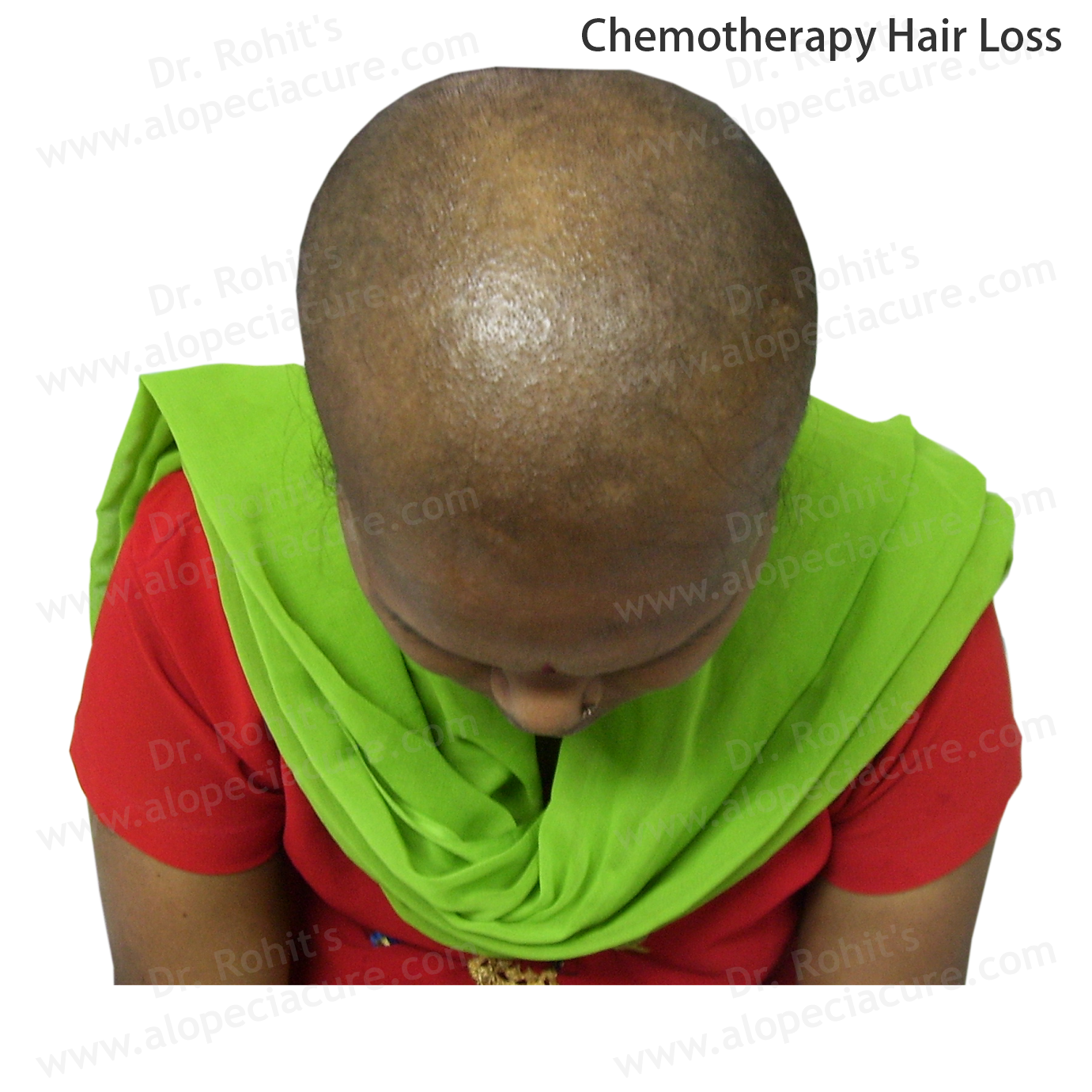 Chemotherapy Hair Loss Clinical Treatment Slide 2