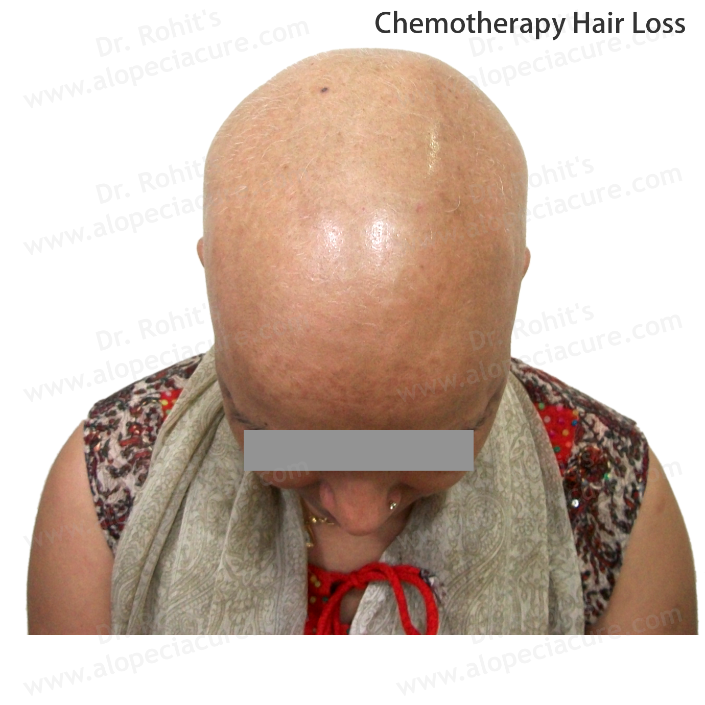 Chemotherapy Hair Loss Clinical Treatment Slide 3