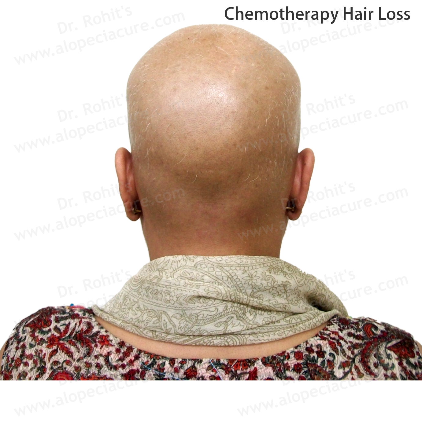 Chemotherapy Hair Loss Clinical Treatment Slide 4