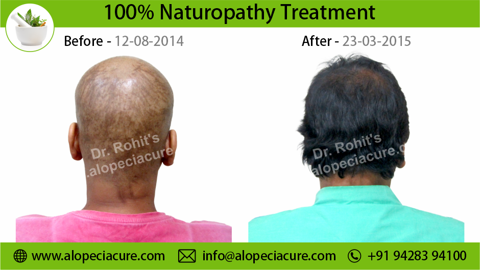 Chemotherapy Hair Loss Treatment Result 1