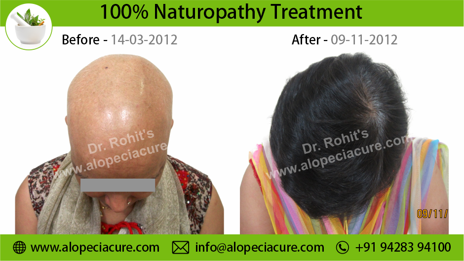 Chemotherapy Hair Loss Treatment Result 2