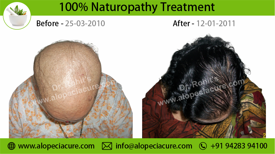 Chemotherapy Hair Loss Treatment Result 3