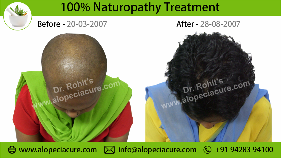 Chemotherapy Hair Loss Treatment Result 4