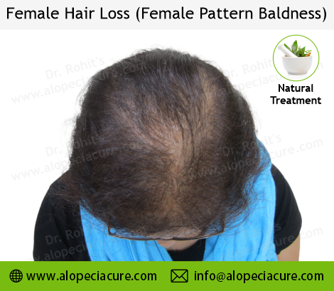 Male Hair Loss Result 1