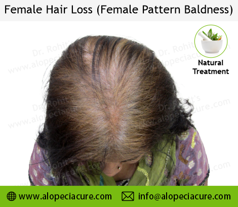 Male Hair Loss Result 2