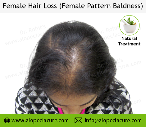 Male Hair Loss Result 3