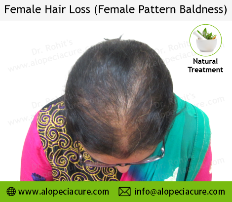 Male Hair Loss Result 4