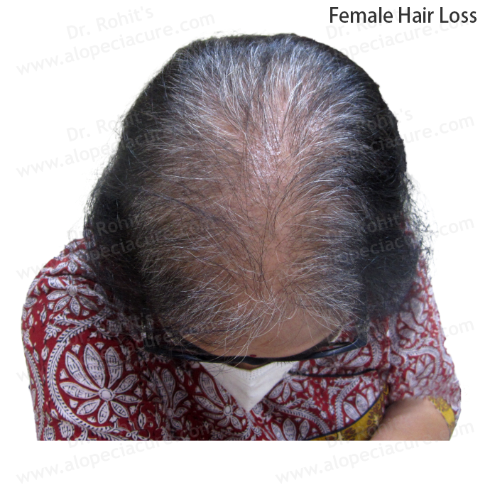 Female Hair Loss Clinical Treatment Slide 1
