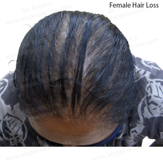 Female Hair Loss Clinical Treatment Slide 2