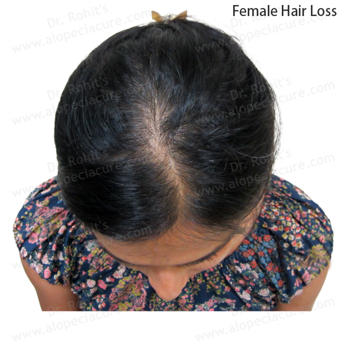 Female Hair Loss Clinical Treatment Slide 3