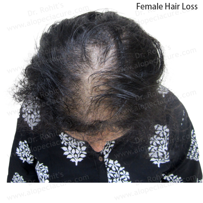 Female Hair Loss Clinical Treatment Slide 4