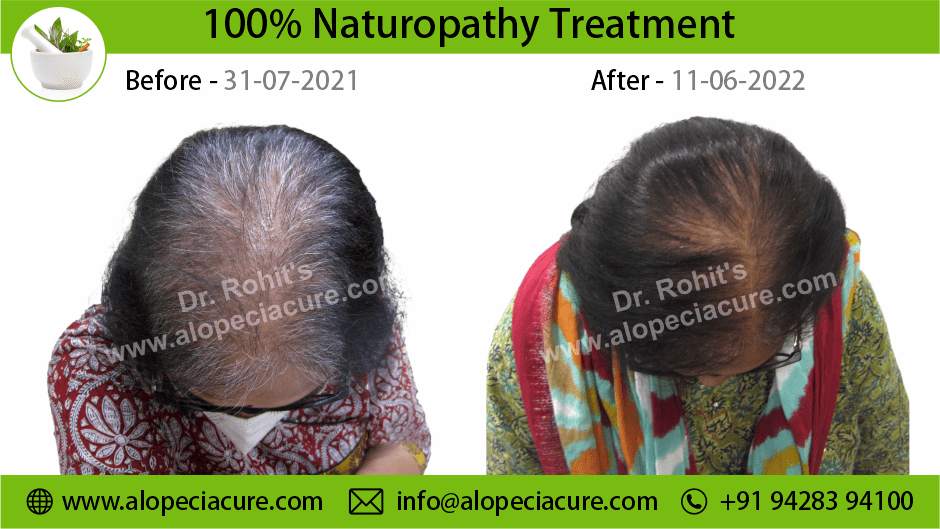 Female Hair Loss Treatment Result 1