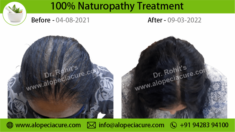 Female Hair Loss Treatment Result 2