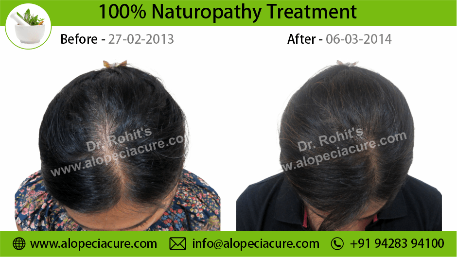 Female Hair Loss Treatment Result 3