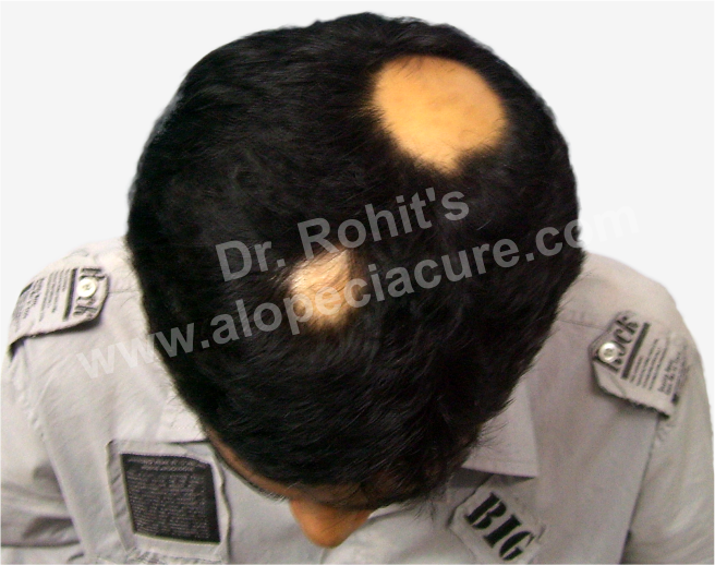 Alopecia Areata