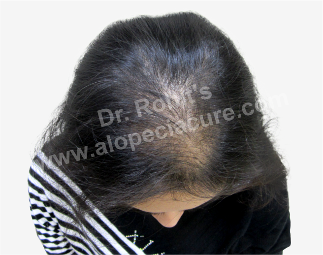 Female Hair Loss