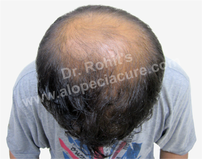 Male Hair Loss