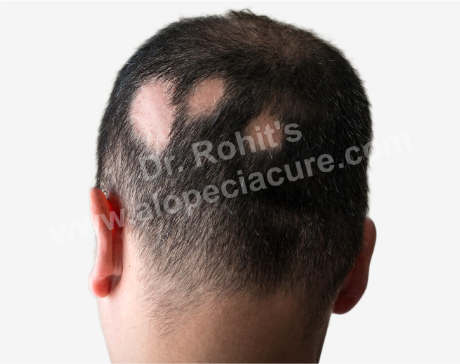 Scarring Alopecia