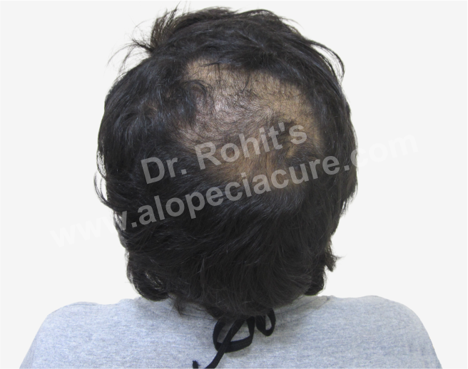 Trichotillomania