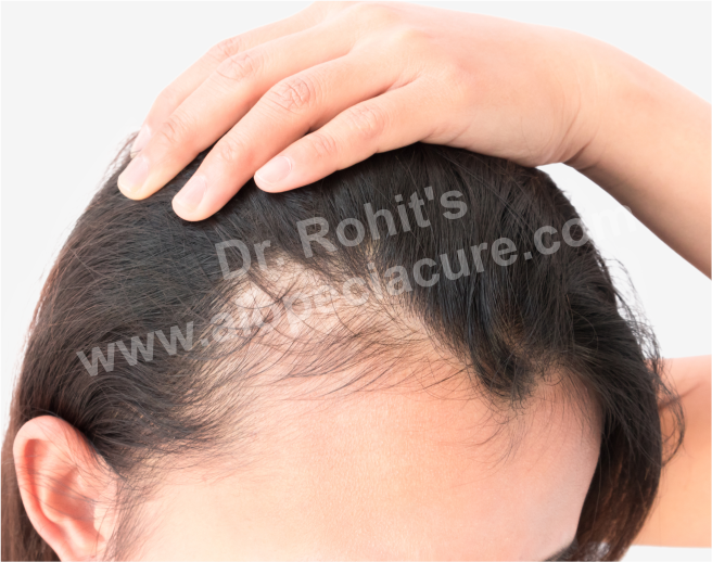 Traction Alopecia