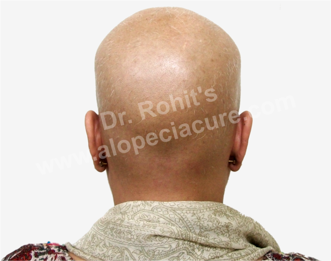 Chemotherapy Hair Loss