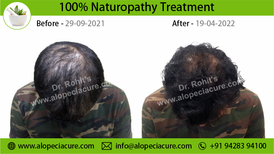 Male Hair Loss Treatment Result 1