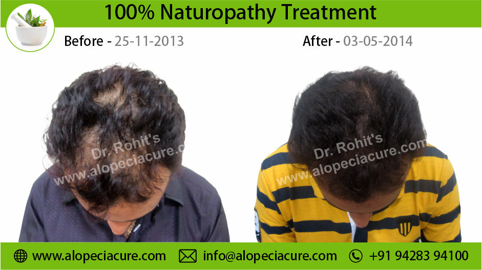 Male Hair Loss Treatment Result 4