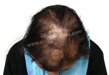Alopecia Totalis