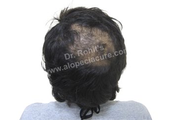 Telogen Effluvium