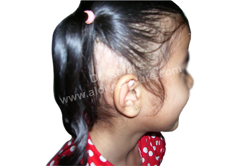 Alopecia Barbae