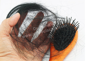 Traction Alopecia