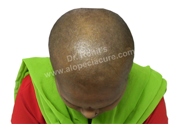Trichotillomania