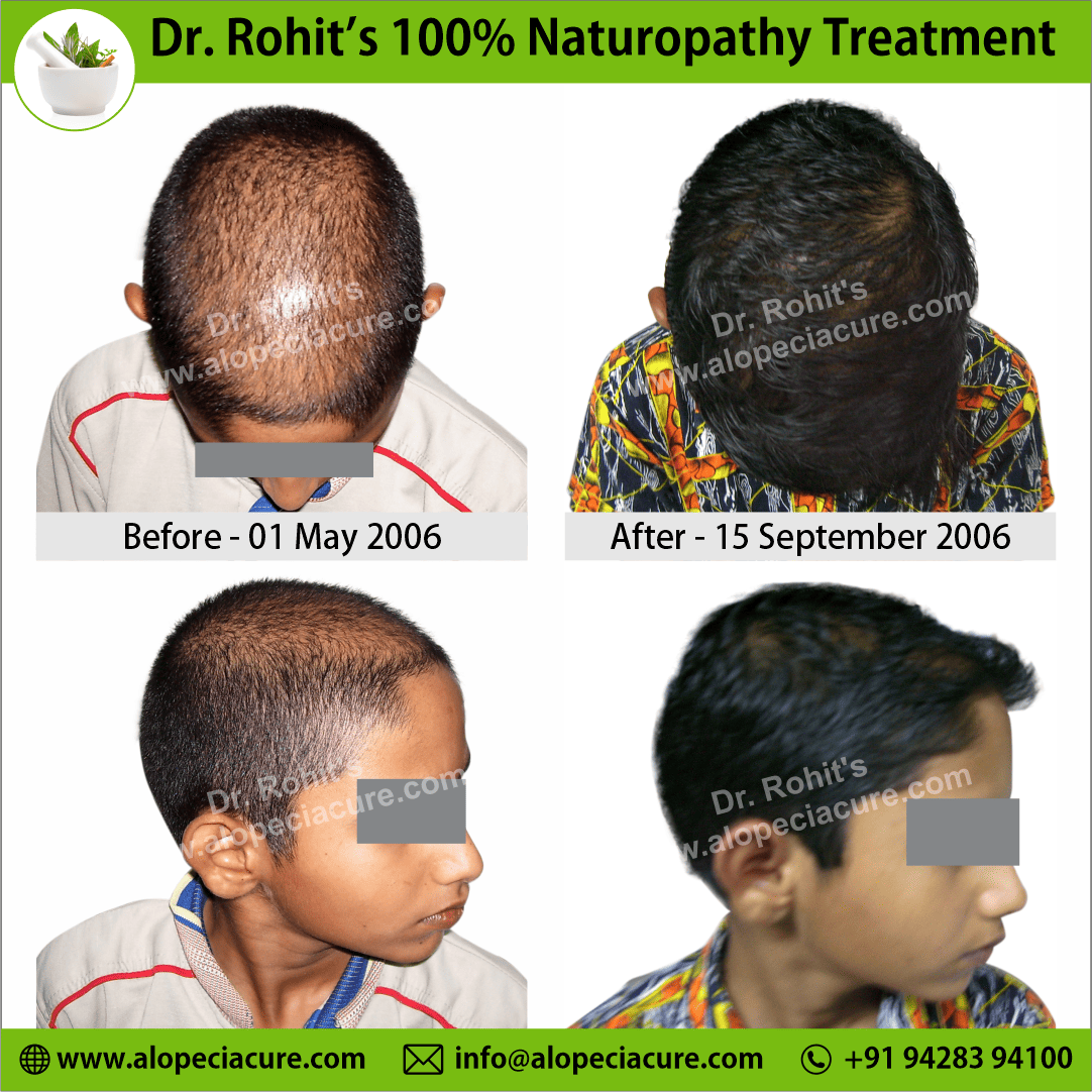 Ophiasis Alopecia Areata Clinical Result