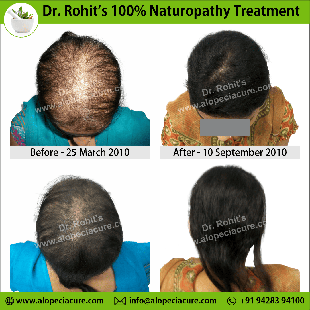 Ophiasis Alopecia Areata Clinical Result