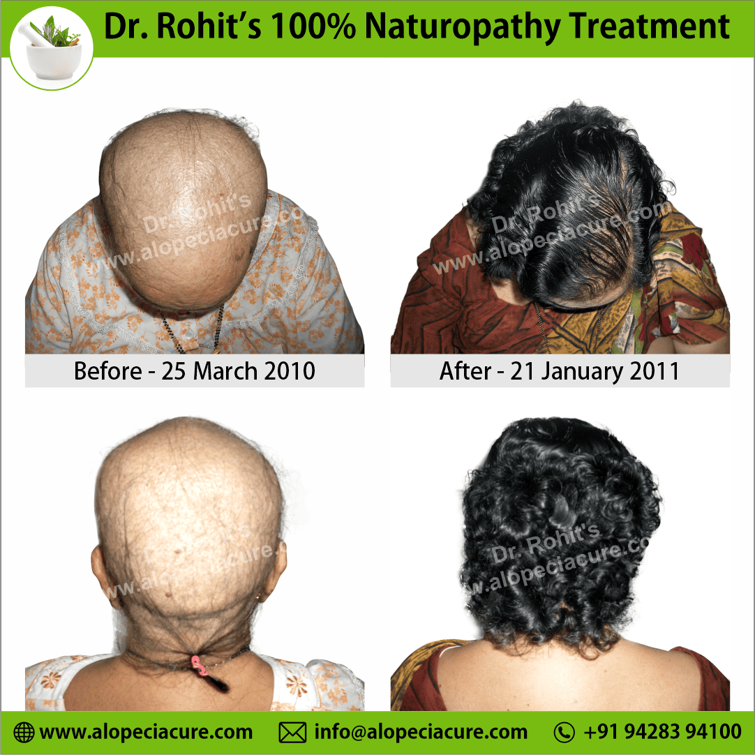 Ophiasis Alopecia Areata Clinical Result