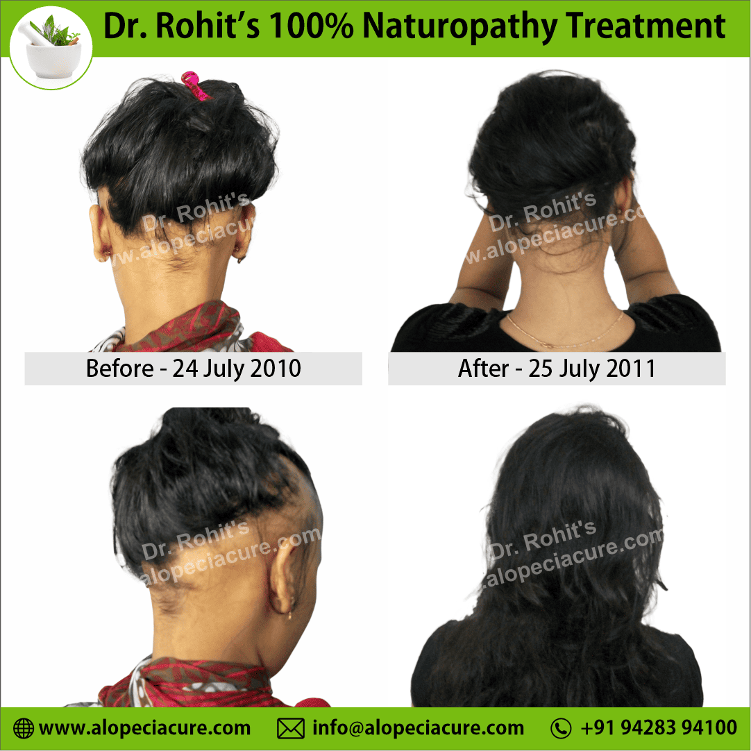 Ophiasis Alopecia Areata Clinical Result