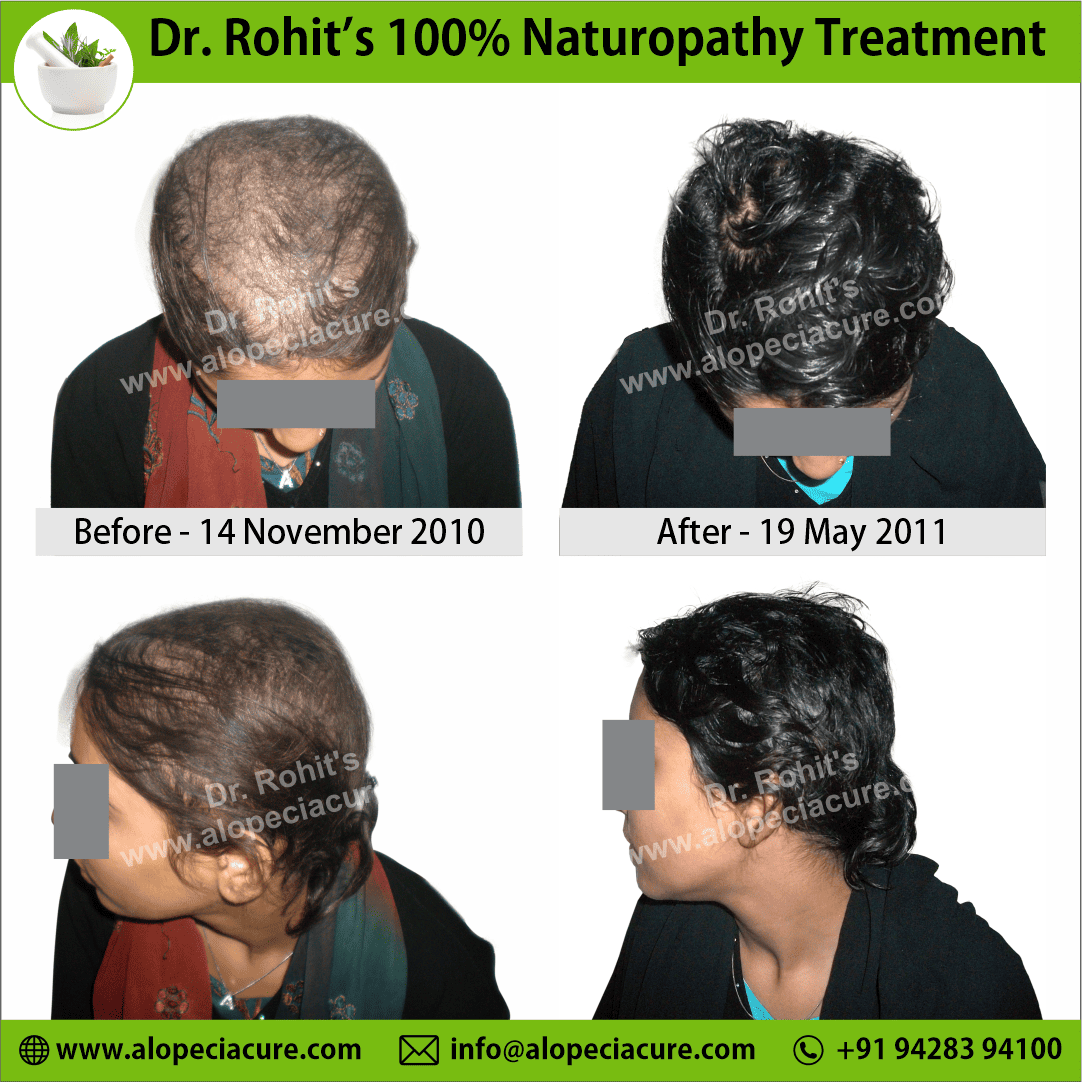 Ophiasis Alopecia Areata Clinical Result