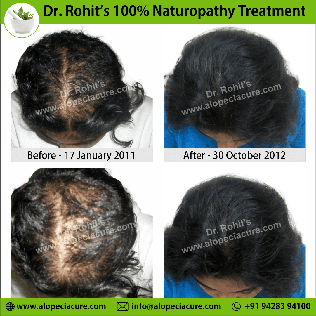 Ophiasis Alopecia Areata Clinical Result