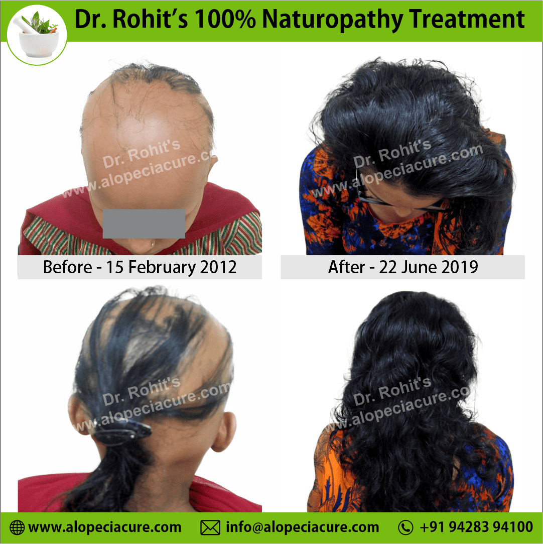 Ophiasis Alopecia Areata Clinical Result