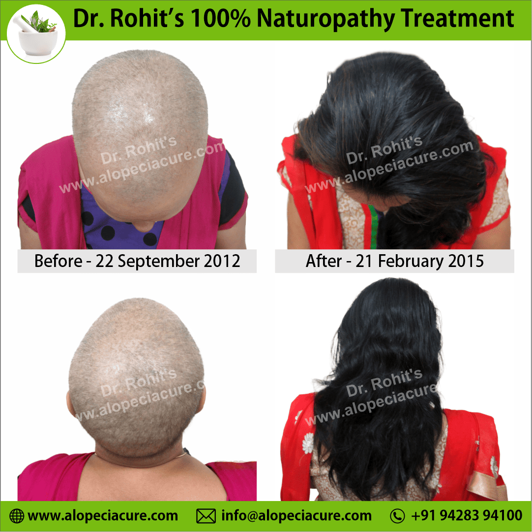 Ophiasis Alopecia Areata Clinical Result