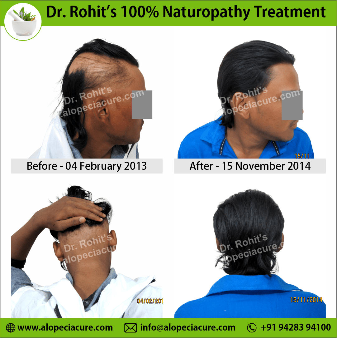 Ophiasis Alopecia Areata Clinical Result