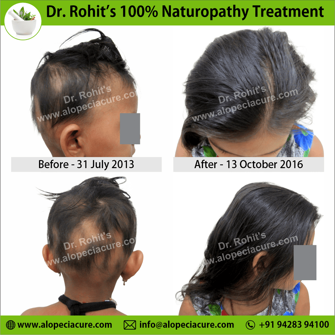 Ophiasis Alopecia Areata Clinical Result