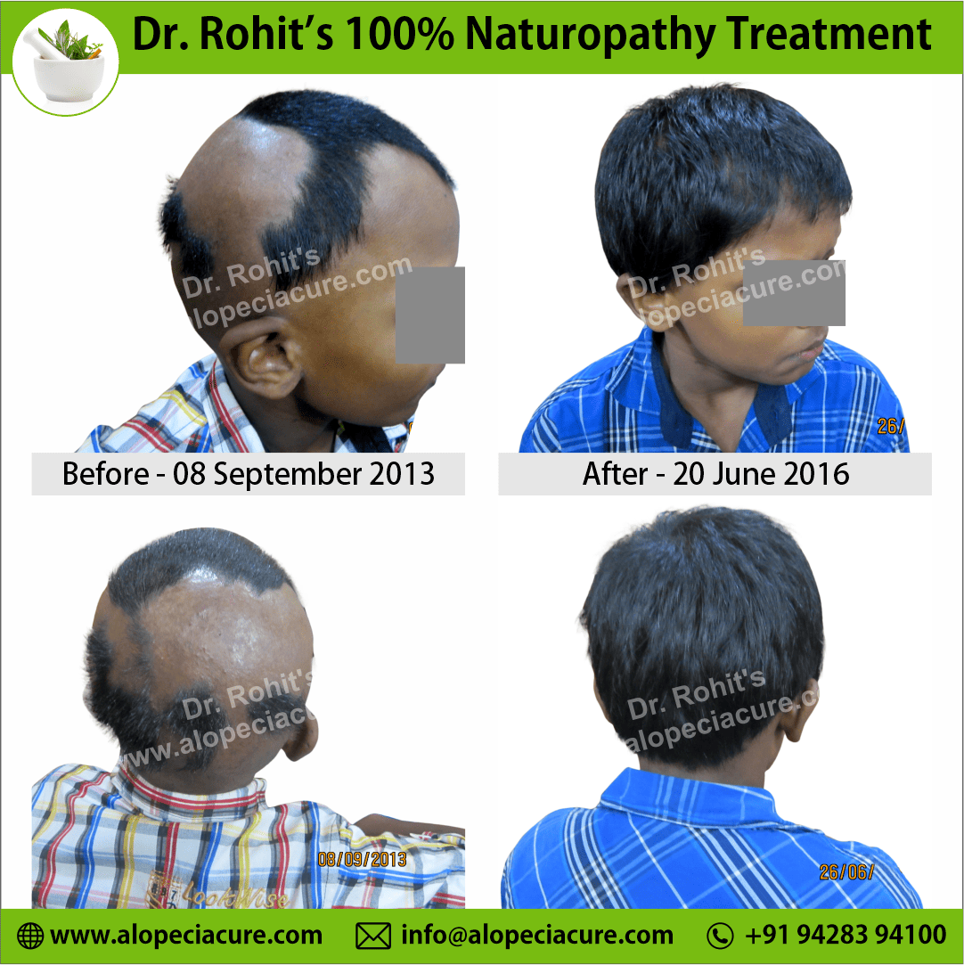 Ophiasis Alopecia Areata Clinical Result