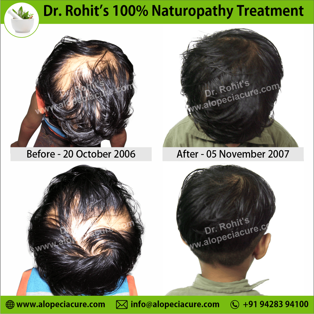 Ophiasis Alopecia Areata Clinical Result