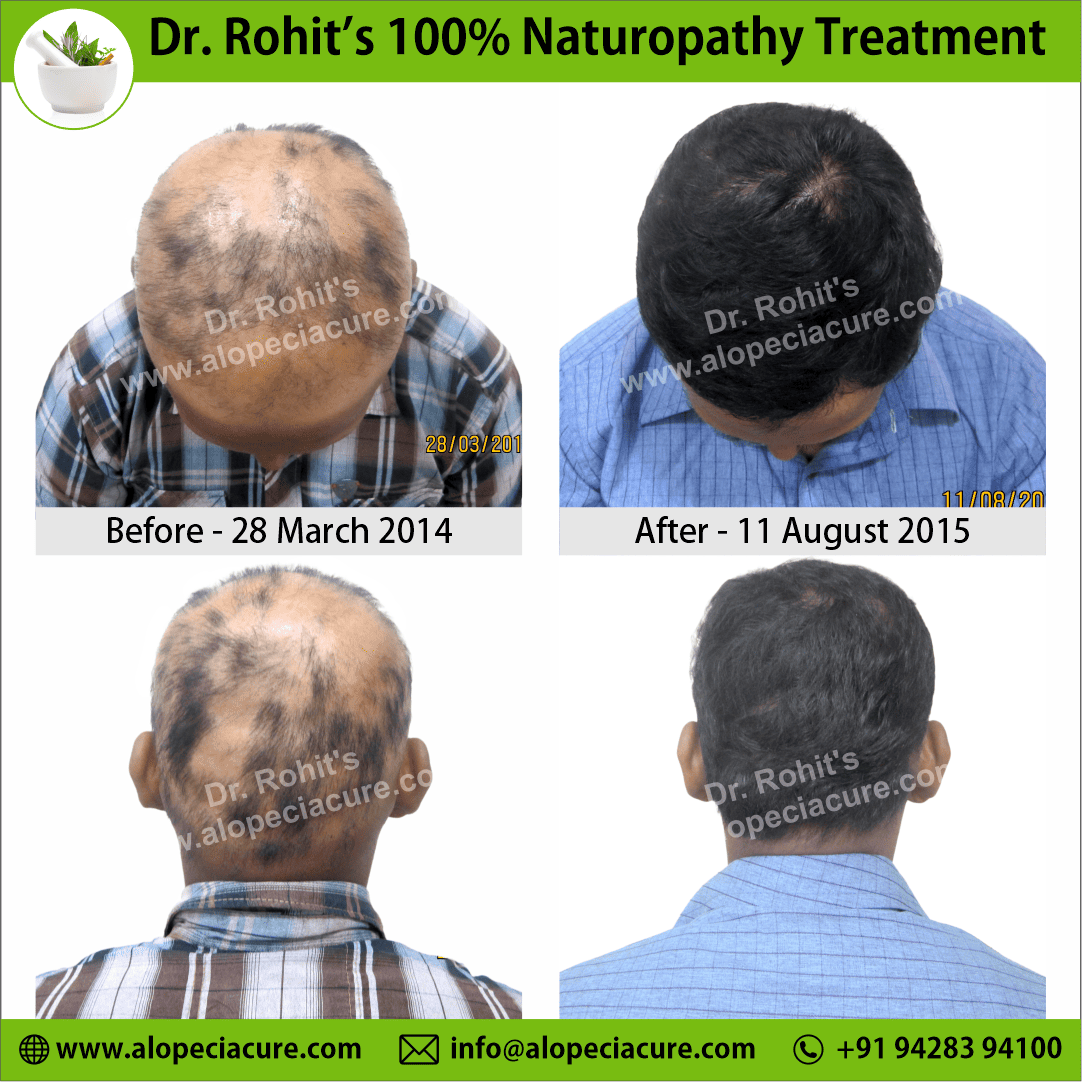 Ophiasis Alopecia Areata Clinical Result