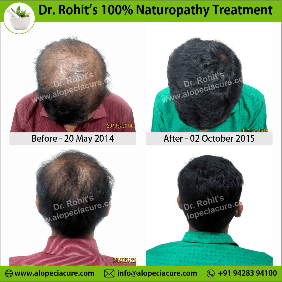 Ophiasis Alopecia Areata Clinical Result