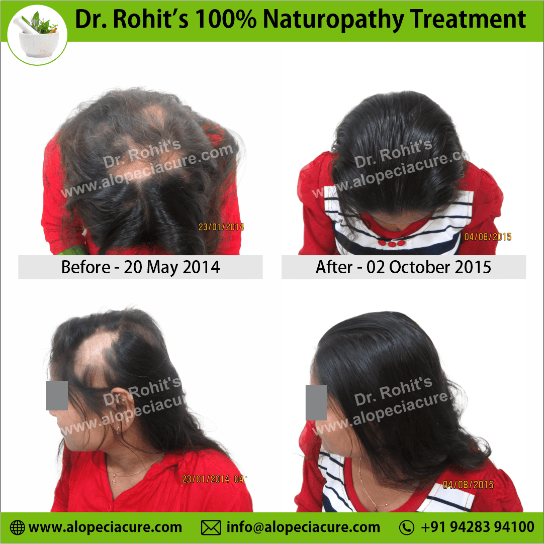 Ophiasis Alopecia Areata Clinical Result